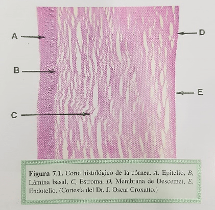 Úlcera corneal 